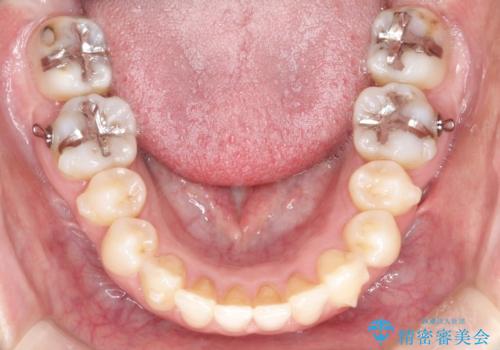 【前歯のがたつきでお悩みの方必見】インビザライン矯正の症例の治療中
