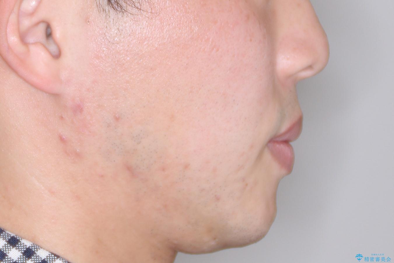 【八重歯・がたつきでお悩みの方必見】抜歯矯正症例(審美ワイヤー矯正)の治療後(顔貌)