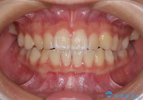 むし歯になりやすい奥歯 補助装置で一気に解決の症例 治療前