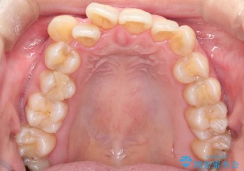 ガタガタの抜歯矯正を裏側ワイヤーを使っての目立たない矯正の治療前