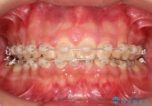 【過蓋咬合・正中離開・奥歯のズレでお悩みの方必見】非抜歯矯正症例(顎骨の成長を利用)の治療中