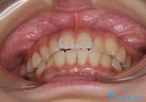 むし歯になりやすい奥歯 補助装置で一気に解決の治療前