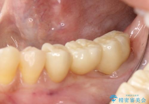 部分矯正してからオールセラミックブリッジの治療後