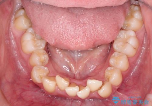 ガタガタの抜歯矯正を裏側ワイヤーを使っての目立たない矯正の治療前