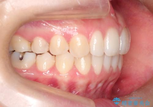 【前歯のがたつきでお悩みの方必見】インビザライン矯正の症例の治療後