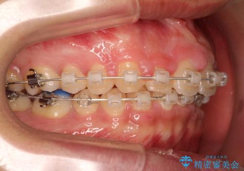 【過蓋咬合・正中離開・奥歯のズレでお悩みの方必見】非抜歯矯正症例(顎骨の成長を利用)の治療中