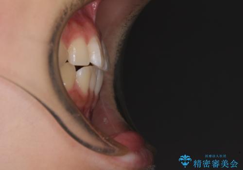 むし歯になりやすい奥歯 補助装置で一気に解決の治療前