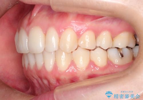 【前歯のがたつきでお悩みの方必見】インビザライン矯正の症例の治療後