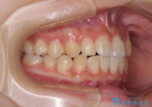 むし歯になりやすい奥歯 補助装置で一気に解決の治療前