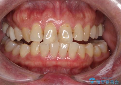 オフィスホワイトニングスペシャルコースの症例 治療前