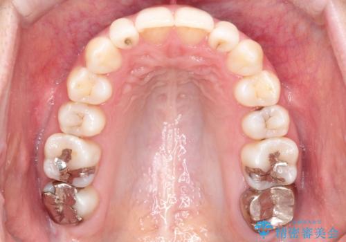【前歯のがたつきでお悩みの方必見】インビザライン矯正の症例の治療後