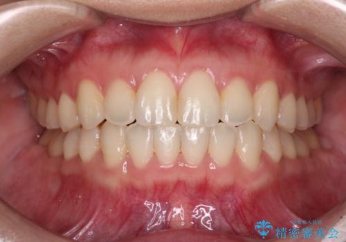 ワイヤー矯正で楽して治療　前歯のデコボコを短期間で改善