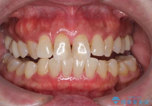 オフィスホワイトニングスペシャルコースの症例 治療後
