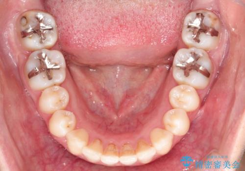 【前歯のがたつきでお悩みの方必見】インビザライン矯正の症例の治療後