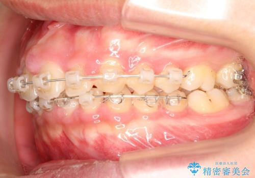【過蓋咬合・正中離開・奥歯のズレでお悩みの方必見】非抜歯矯正症例(顎骨の成長を利用)の治療中