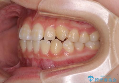 むし歯になりやすい奥歯 補助装置で一気に解決の治療前