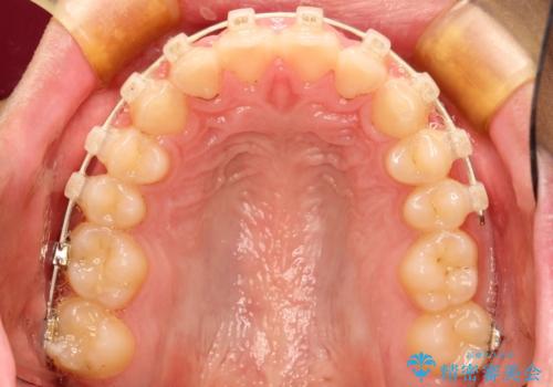 【過蓋咬合・正中離開・奥歯のズレでお悩みの方必見】非抜歯矯正症例(顎骨の成長を利用)の治療中