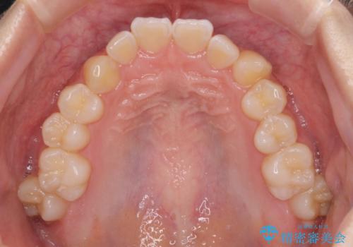 むし歯になりやすい奥歯 補助装置で一気に解決の治療前