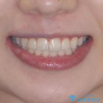 八重歯を改善　目立たないワイヤー装置での矯正治療の治療後（顔貌）