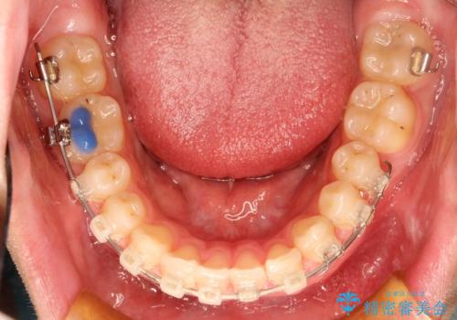 【過蓋咬合・正中離開・奥歯のズレでお悩みの方必見】非抜歯矯正症例(顎骨の成長を利用)の治療中