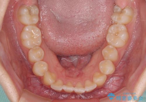 むし歯になりやすい奥歯 補助装置で一気に解決の治療前