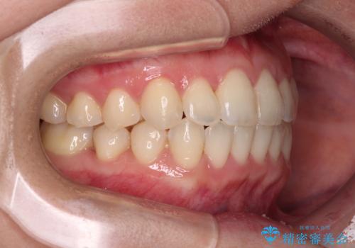 ワイヤー矯正で楽して治療　前歯のデコボコを短期間で改善の治療後