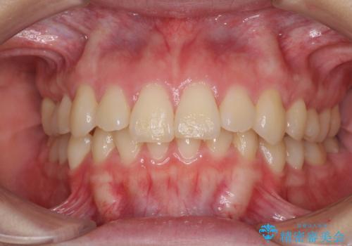 上顎前突 目立たないワイヤー装置での抜歯矯正の症例 治療前