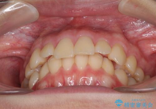 上顎前突 目立たないワイヤー装置での抜歯矯正の治療前