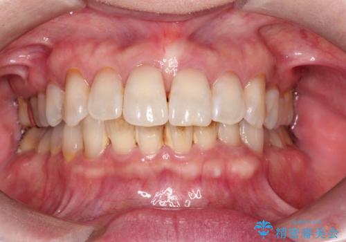PMTCでステイン除去をし綺麗な歯への治療前