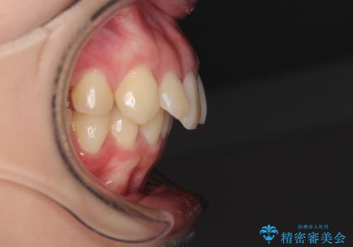 上顎前突 目立たないワイヤー装置での抜歯矯正の治療前