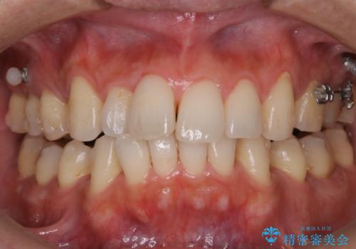 矯正中のクリーニング(PMTC)