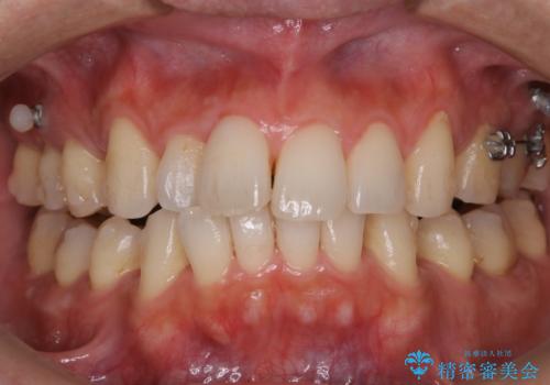 2ヶ月に1回ペースでクリーニング(PMTC)の症例 治療前