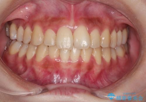 術前クリーニング+オフィスホワイトニングスペシャルコースの症例 治療前