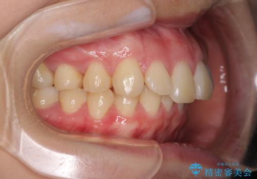 上顎前突 目立たないワイヤー装置での抜歯矯正の治療前