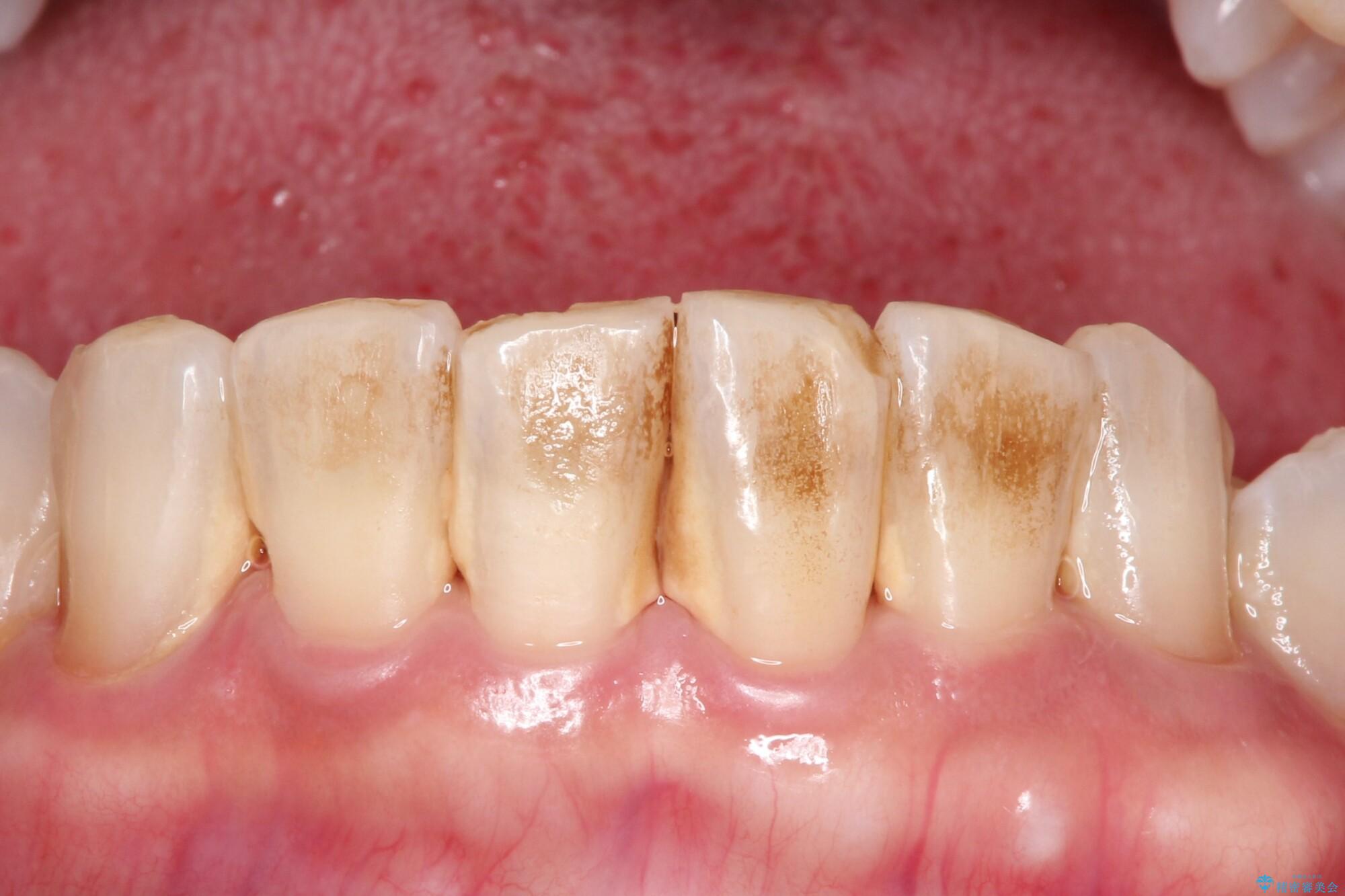 PMTCでステイン除去をし綺麗な歯への治療前（顔貌）