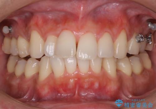矯正中のクリーニング(PMTC)の症例 治療後