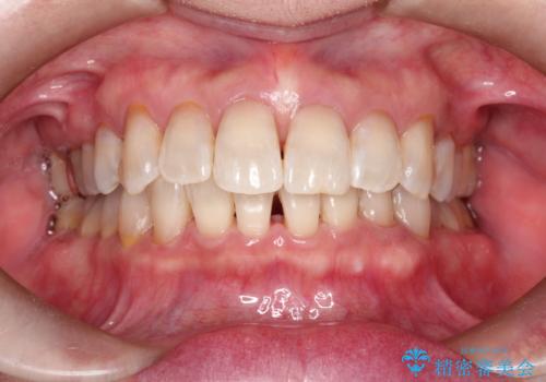 PMTCでステイン除去をし綺麗な歯への治療後