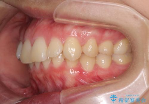 上顎前突 目立たないワイヤー装置での抜歯矯正の治療前