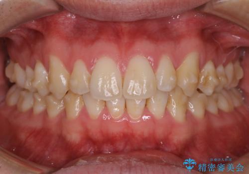 インビザライン中の着色落とし(PMTC)の症例 治療前