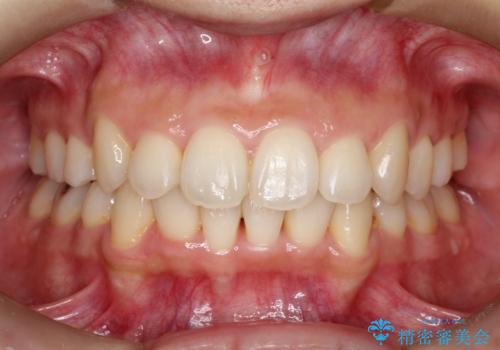 【八重歯・重度のがたつきでお悩みの方必見】抜歯矯正症例(審美ワイヤー矯正)の症例 治療後