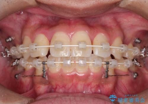 【八重歯・がたつきでお悩みの方必見】抜歯矯正症例(審美ワイヤー矯正)の治療中