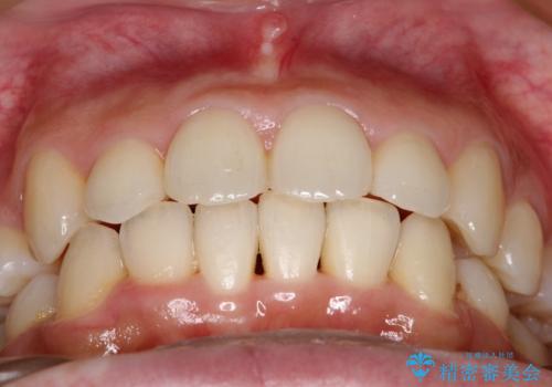 【八重歯・重度のがたつきでお悩みの方必見】抜歯矯正症例(審美ワイヤー矯正)の治療後