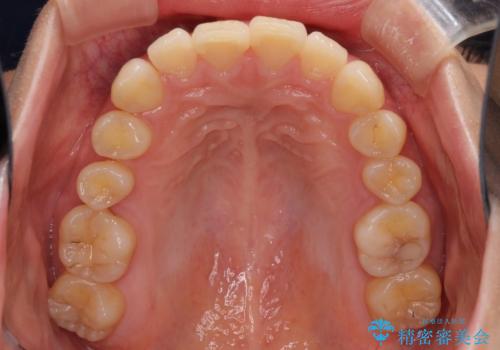 上顎前突 目立たないワイヤー装置での抜歯矯正の治療前