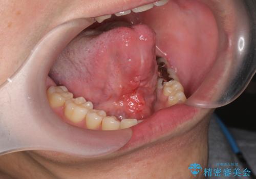 [ 舌小帯の長い付着 ]   舌の動きが悪く話しづらいの治療後