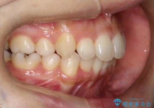 【八重歯・重度のがたつきでお悩みの方必見】抜歯矯正症例(審美ワイヤー矯正)の治療後