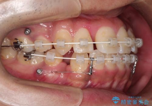 【八重歯・がたつきでお悩みの方必見】抜歯矯正症例(審美ワイヤー矯正)の治療中