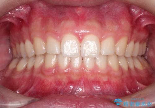 【過蓋咬合・正中離開・奥歯のズレでお悩みの方必見】非抜歯矯正症例(顎骨の成長を利用)の症例 治療後