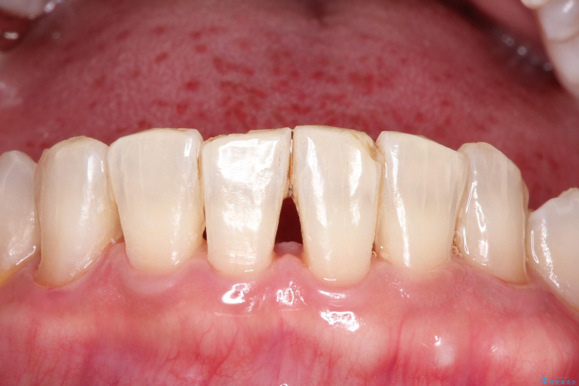 PMTCでステイン除去をし綺麗な歯への治療後（顔貌）