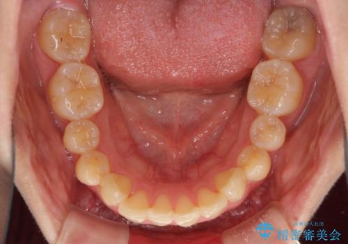 上顎前突 目立たないワイヤー装置での抜歯矯正の治療前