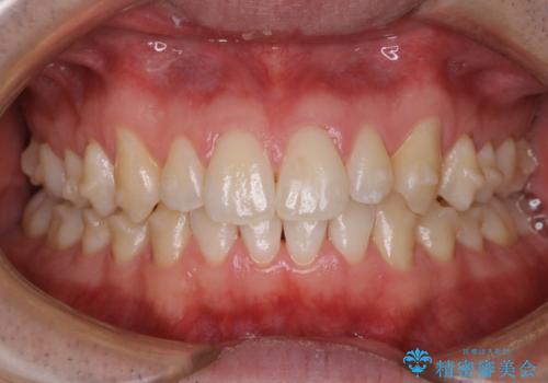 インビザライン中の着色落とし(PMTC)の症例 治療後